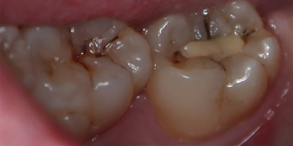 Лечение кариеса 47 зуба