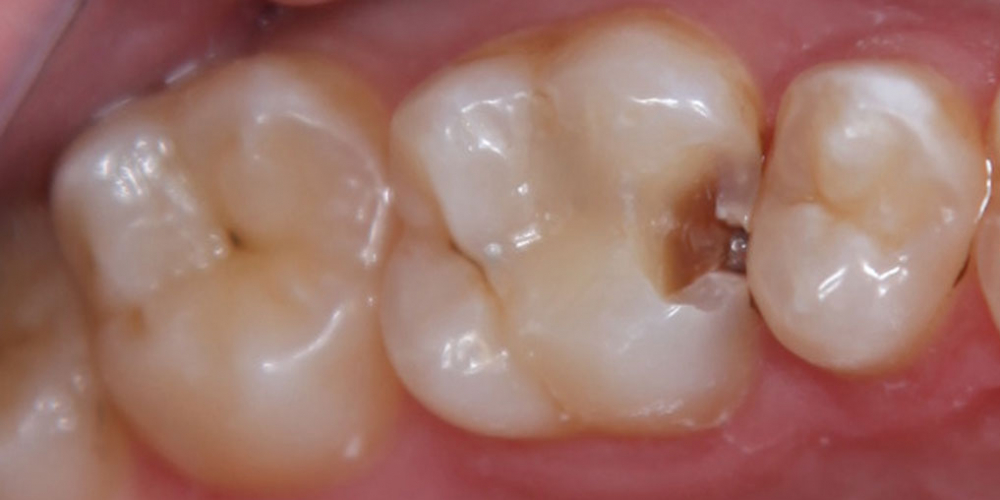  Кариозная полость на контактной поверхности зуба 2.6