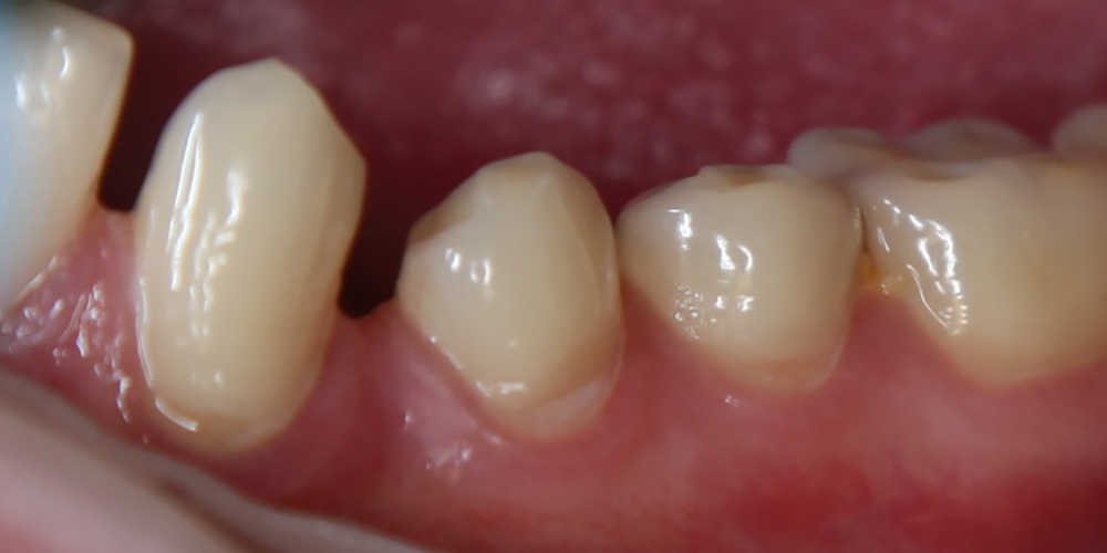  Лечение клиновидного дефекта 3-х зубов