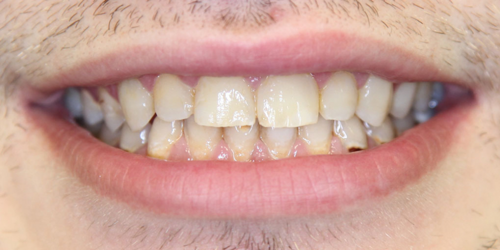  Реставрация 8 верхних зубов: резцов, клыков и премоляров