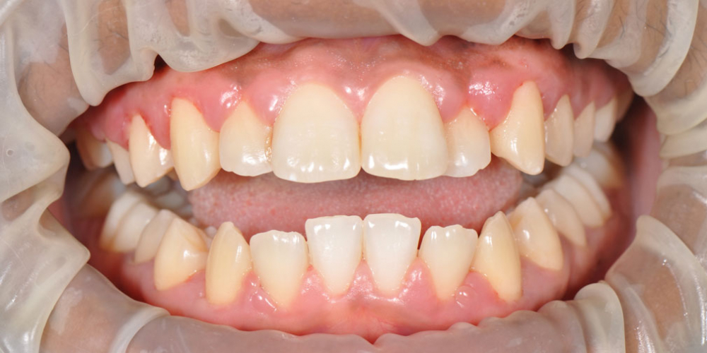 Результат профессиональной чистки зубов от темного налета