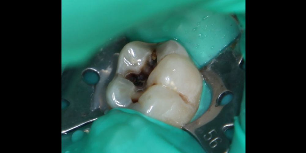  Результат лечения кариеса с восстановлением анатомической формы зуба