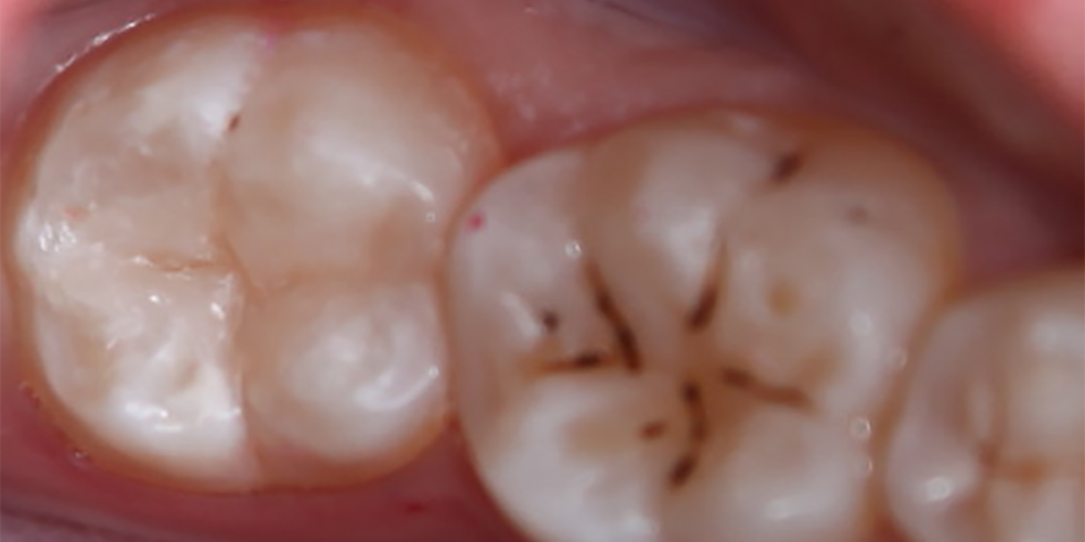  Лечение кариеса зуба 3.7