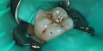 Лечение кариеса 46 зуба фото до лечения