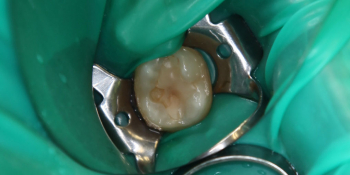 Лечение кариеса 37 зуба фото до лечения