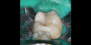 Результат лечения кариеса с восстановлением анатомической формы зуба фото после лечения