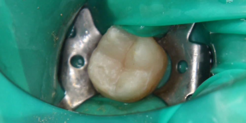  Лечение кариеса 37 зуба