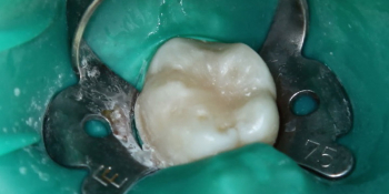 Лечение кариеса 46 зуба фото после лечения