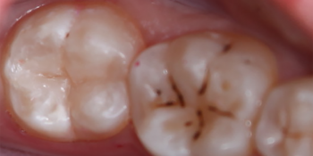Лечение кариеса зуба 3.7 фото после лечения